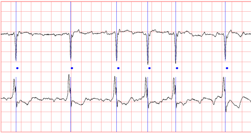 sample ecg recording