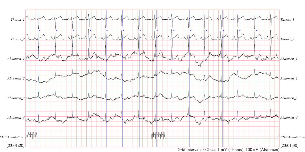 Sample of abdominal non-invasive fetal electrocardiogram (FECG) recording