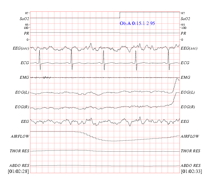 a five-second excerpt of record 0000 from the SHHS Polysomnography Database