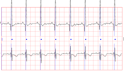 Sinus Rhythm Chart