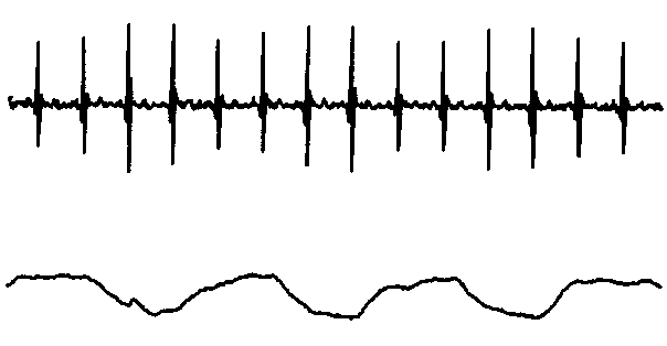 [EDR and PRT signals]