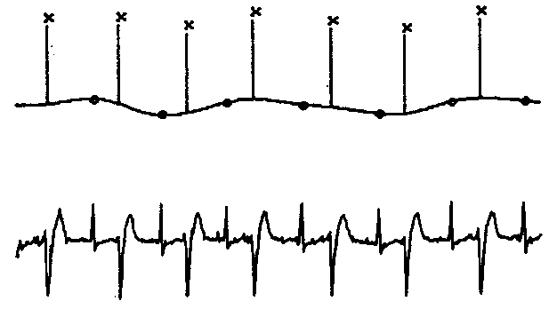 [EDR during ventricular bigeminy]